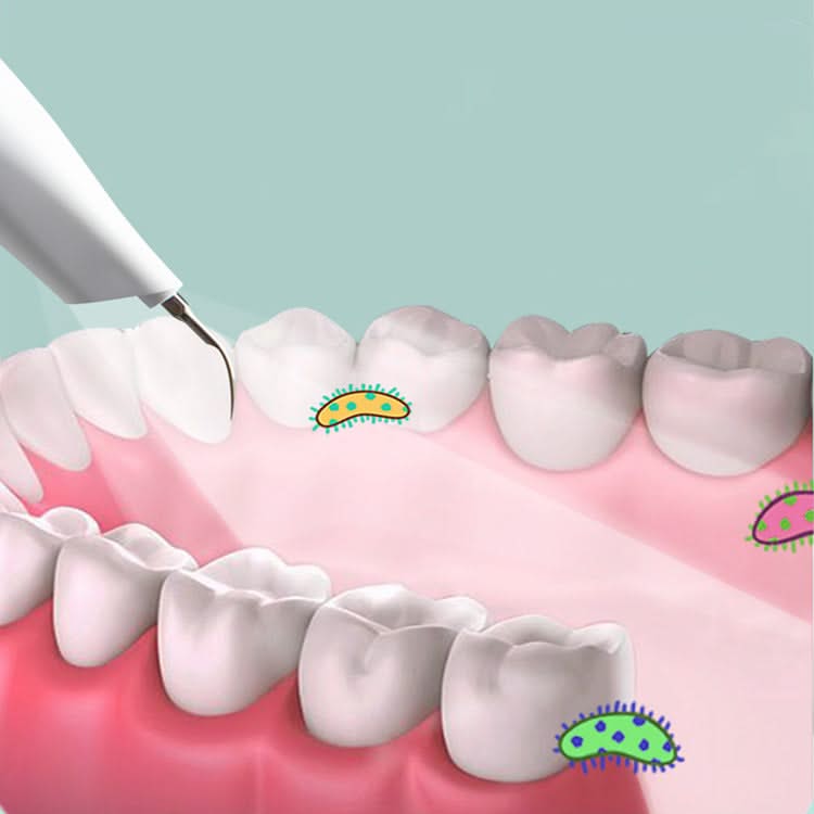 Mauzari™ Pulitore Dentale a Ultrasuoni per Placca, Tartaro e Macchie