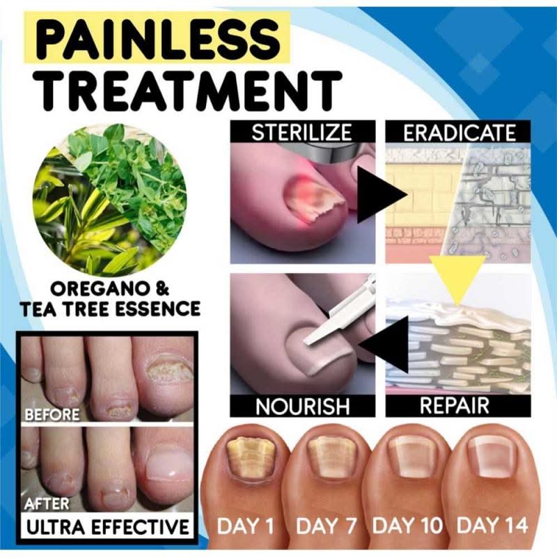 Mauzari™ Kit per il Trattamento delle Micosi delle Unghie